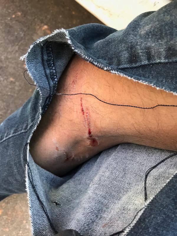 Outdoor Living Tip of the Day – Dog Bites